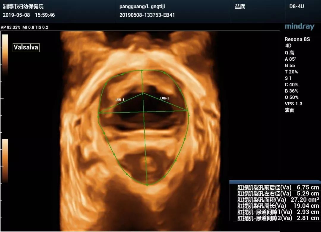 (盆底正中矢状切面valsalva状态)(盆底正中矢状切面静息状态)关爱女性