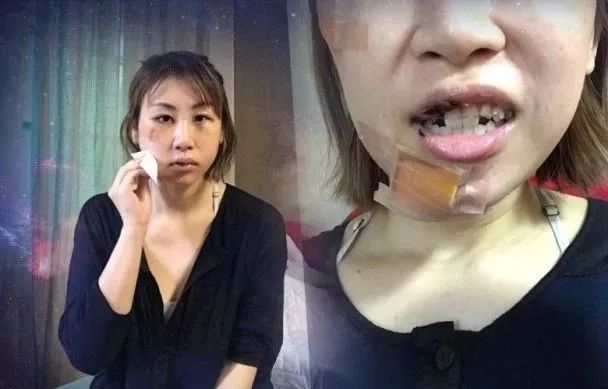 意外毁容,被x骚扰!如今又自爆遭家暴.