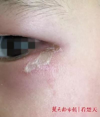 女孩随手拍死一只小虫,一觉醒来半边脸烂了!