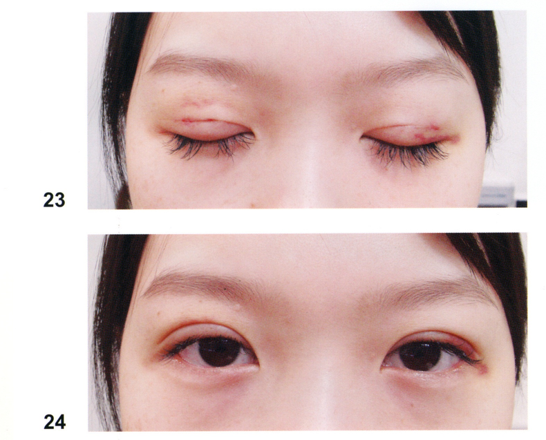 眼部整形重睑术详细介绍