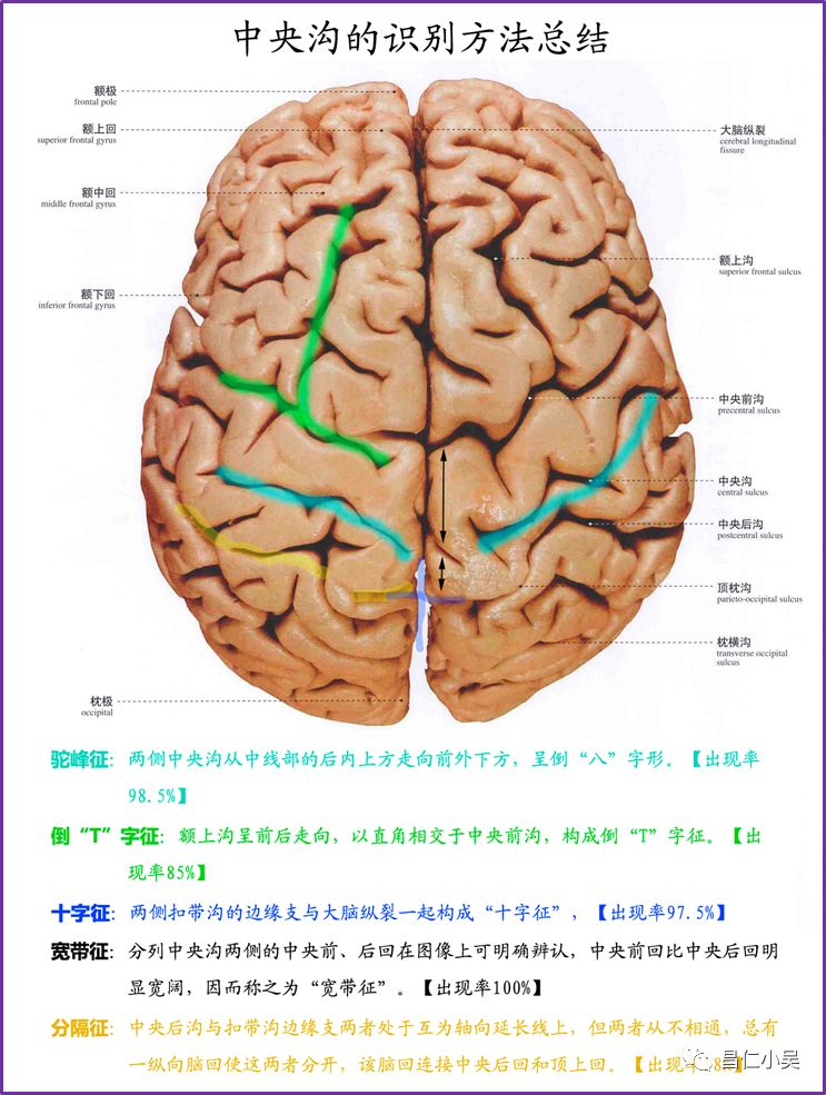 大脑半球三条沟图片