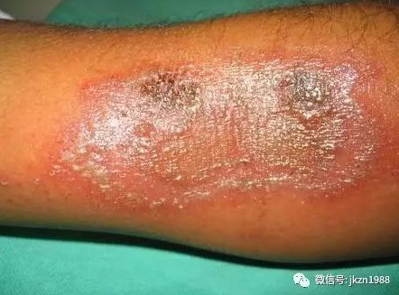 东营人当心有人被这种虫子咬后半边脸烂了不少人中招