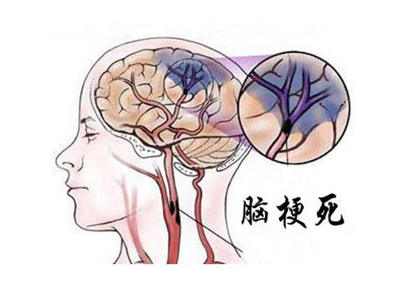 手脚出现4种症状脑梗来了不想常年吃药少做这4件事