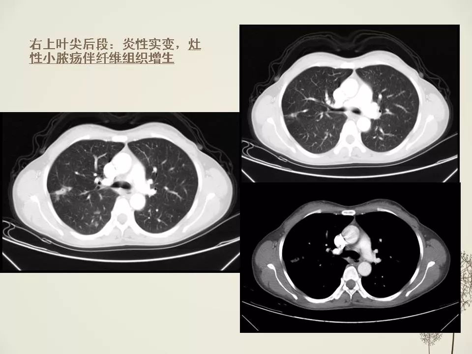 少见良性肺结节ct表现影像天地