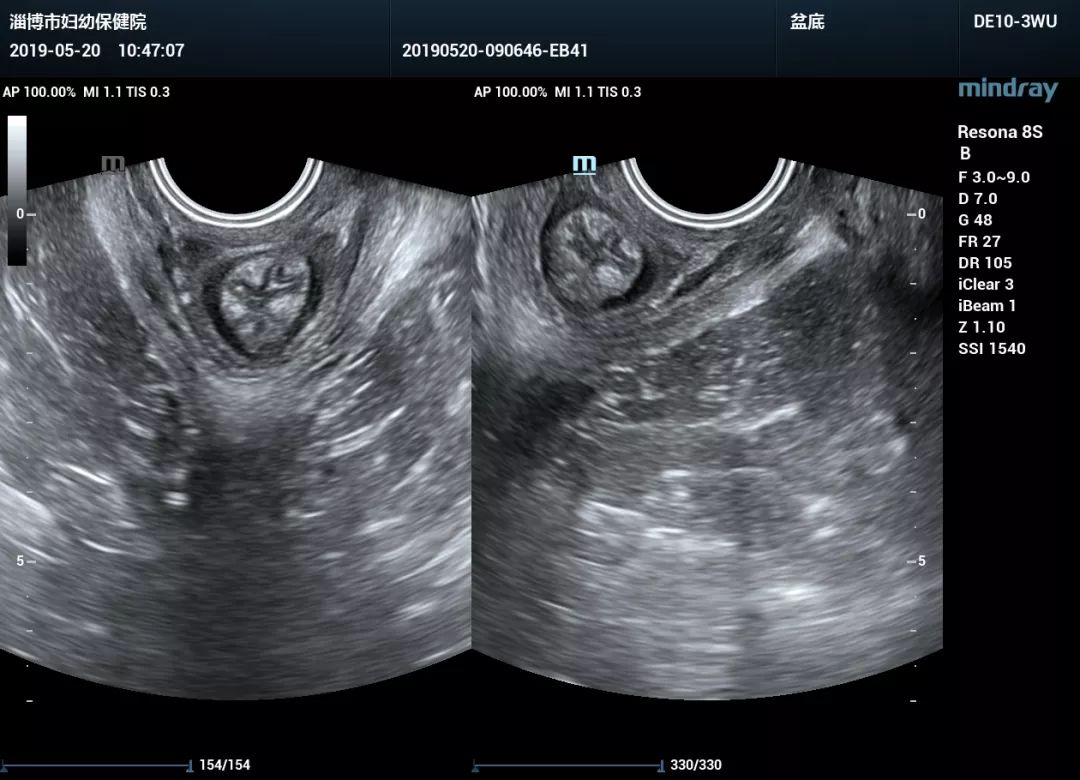 便民惠民好消息淄博市妇幼保健院盆底超声开诊啦