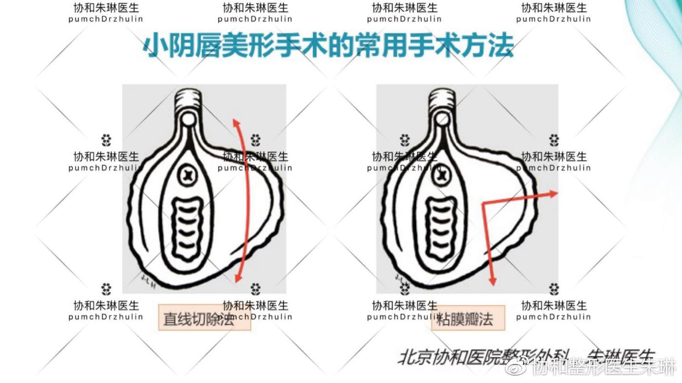 朱琳医生讲私密整形(四)小阴唇肥大手术方法科普 (原创)
