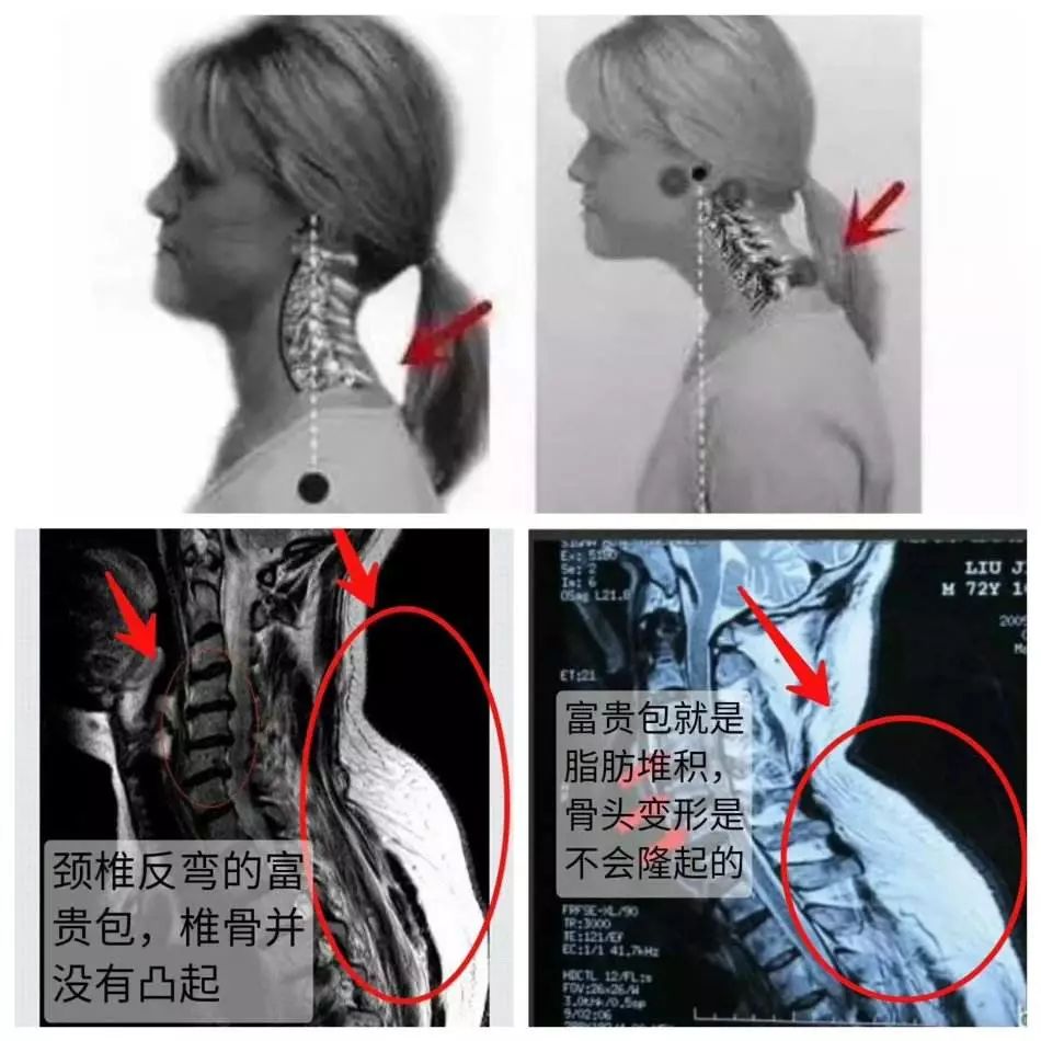 颈椎大椎骨突出图片图片