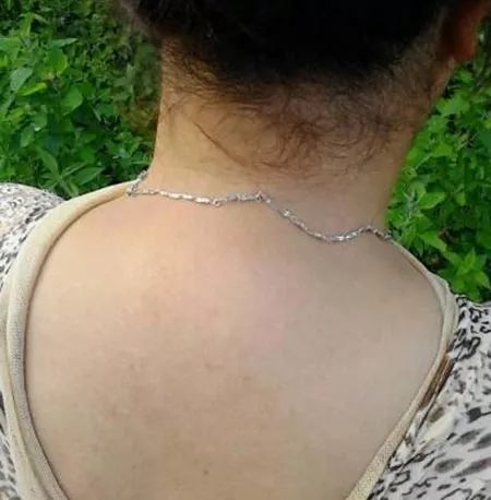 你可知道颈部的富贵包