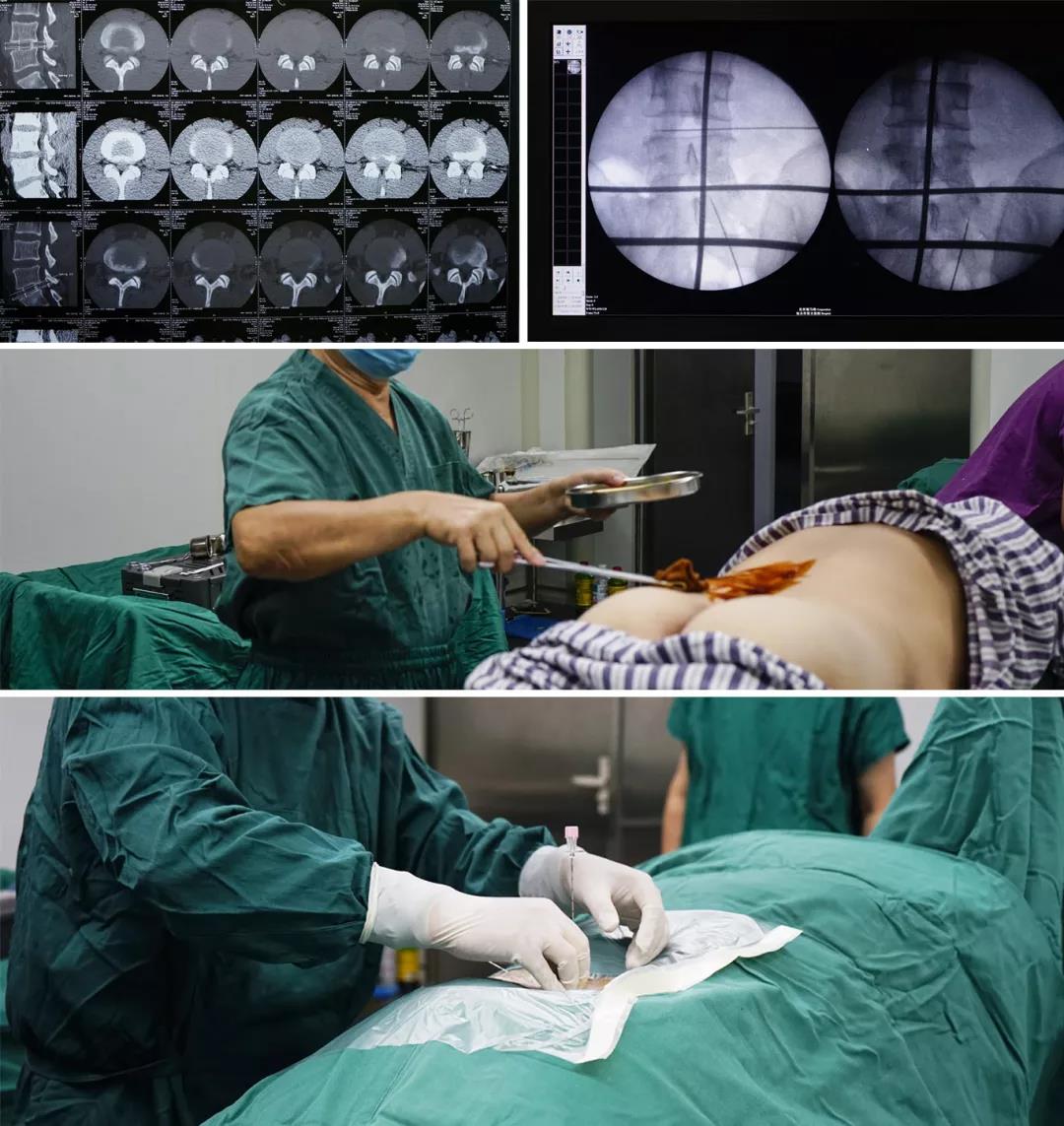 太原同济颈腰椎病医院手术实拍椎间孔镜手术治疗腰椎间盘突出症原理