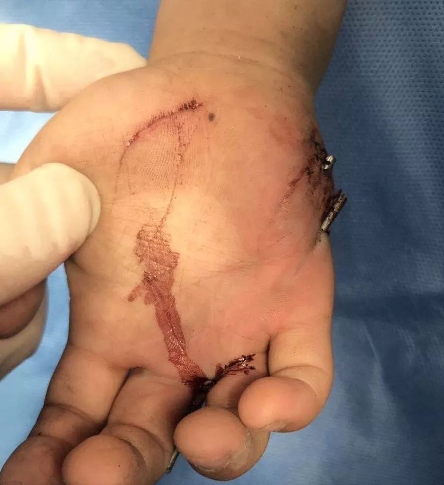 四岁男童玩耍手掌不慎插入电缆线,儿童安全时刻不能放松!