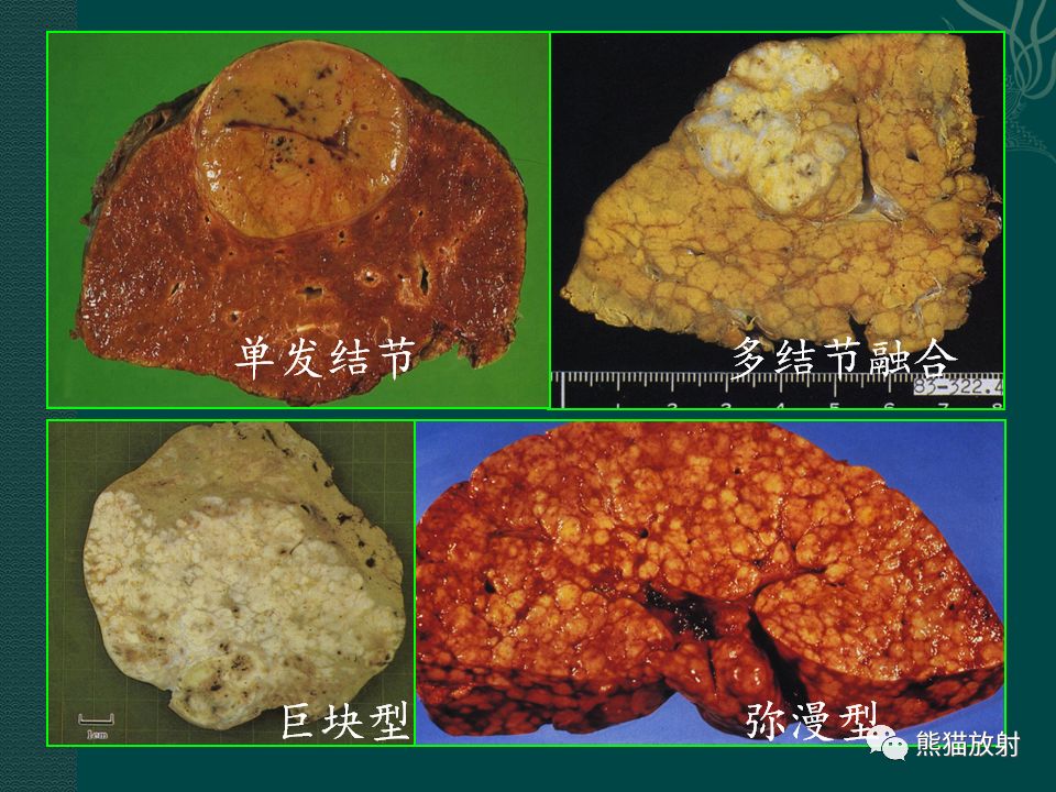 肝脏常见病变丨ct及mri诊断