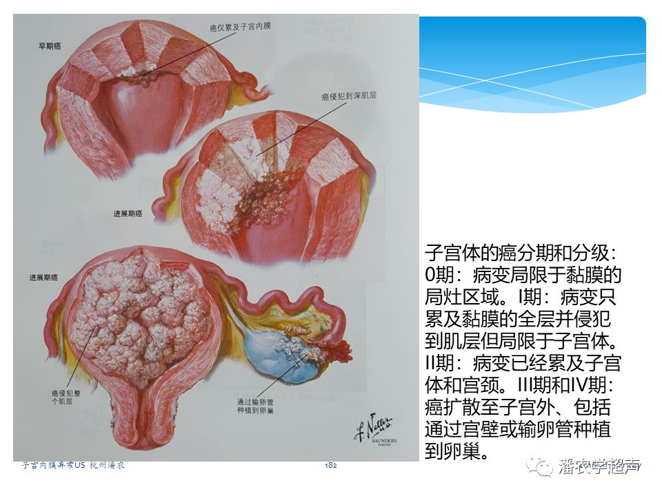 子宫内膜癌的超声诊断