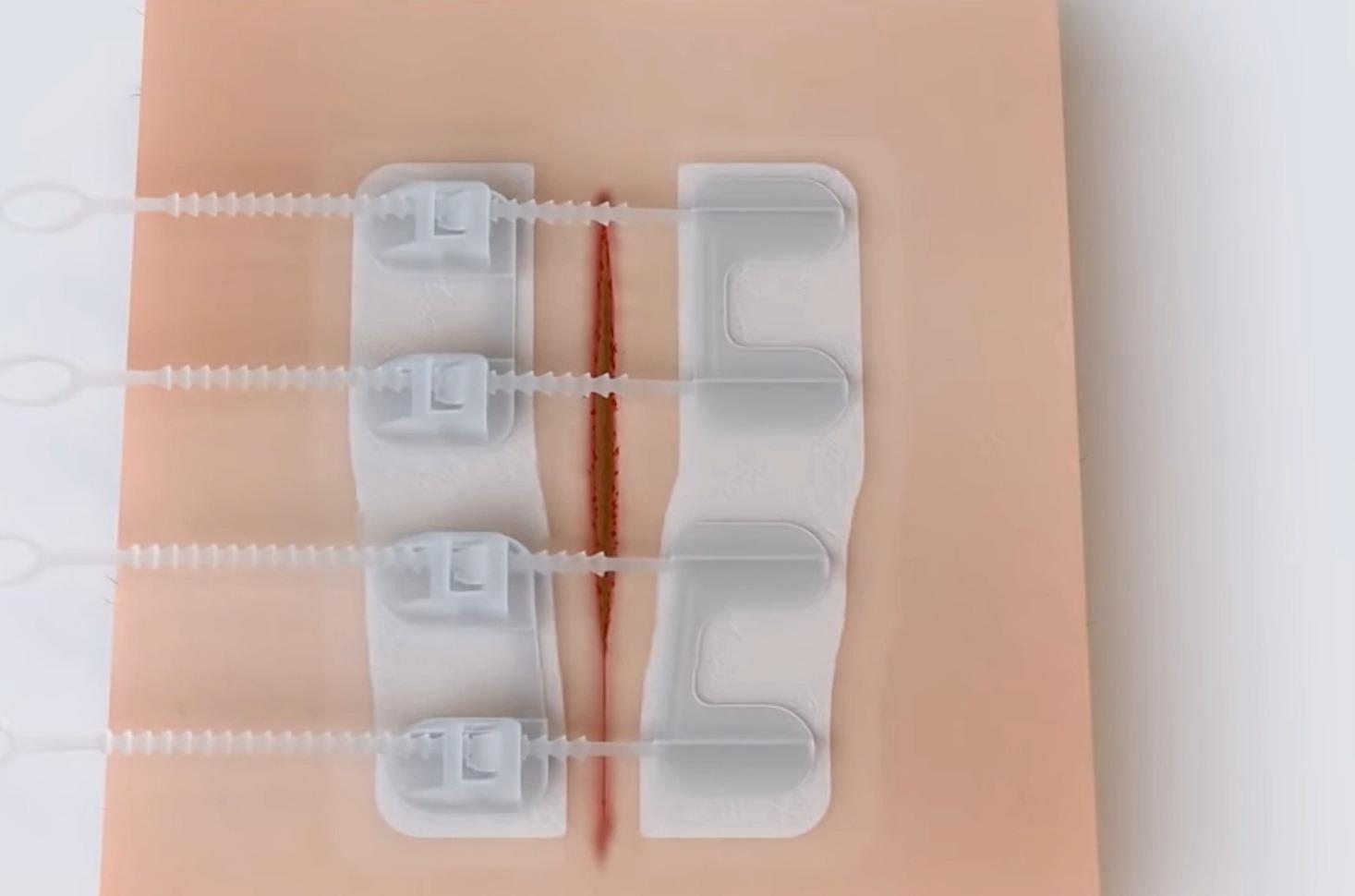 外国发明新型拉链创可贴,治疗更快更方便,国内为什么仍很少见?