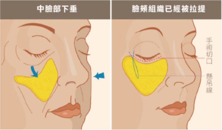 法令纹 -颧脂肪垫和颊脂肪垫向下,向前移动.