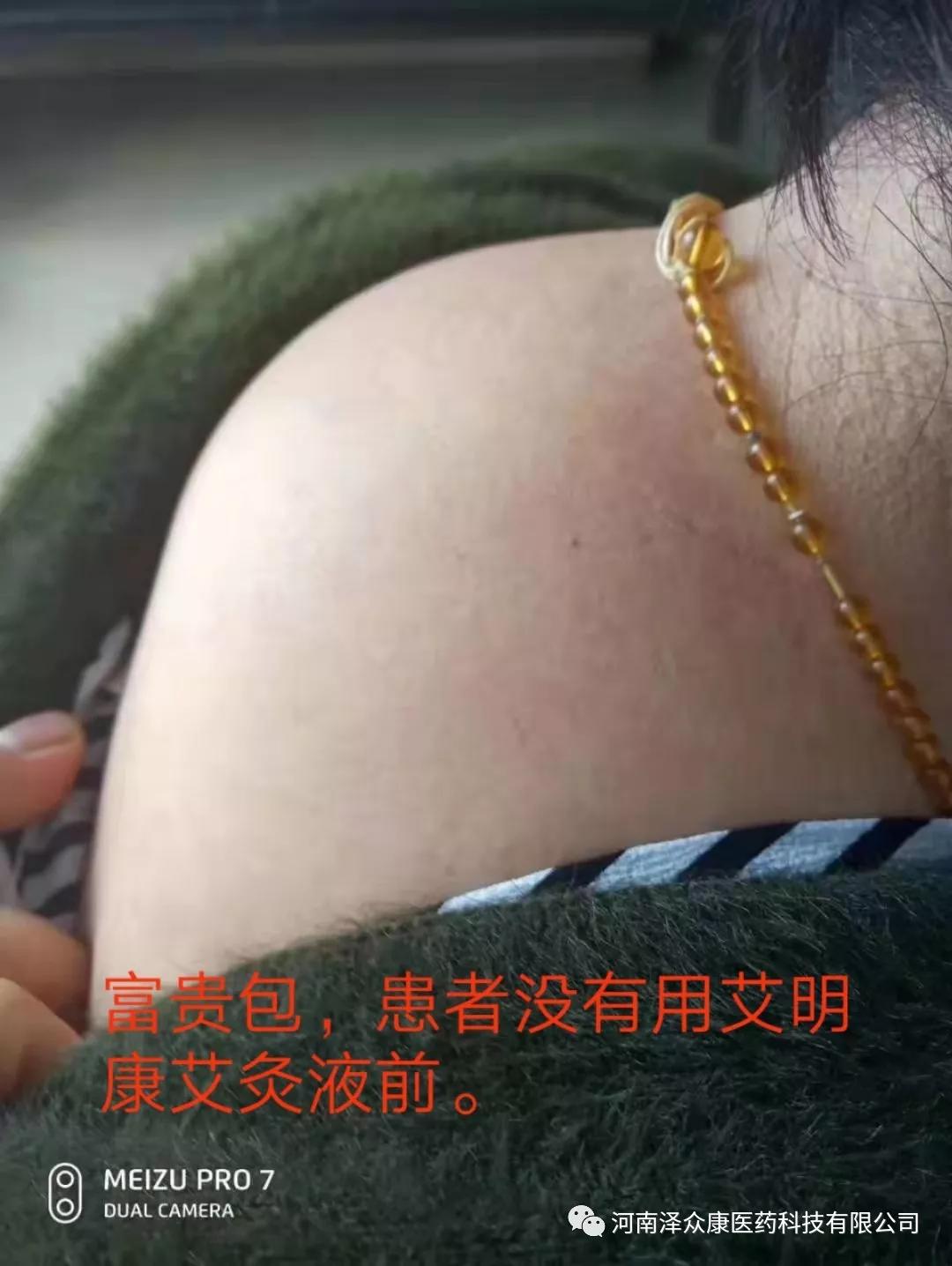 8个方法消除富贵包而即使没有明显的凸起,头部贴不