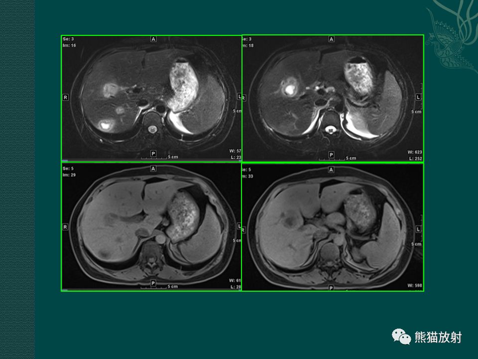 肝臟常見病變丨ct及mri診斷