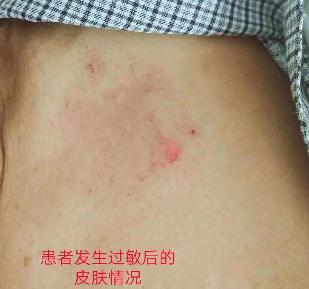 电极片过敏致皮肤破溃这样改良实特高明一箭双雕