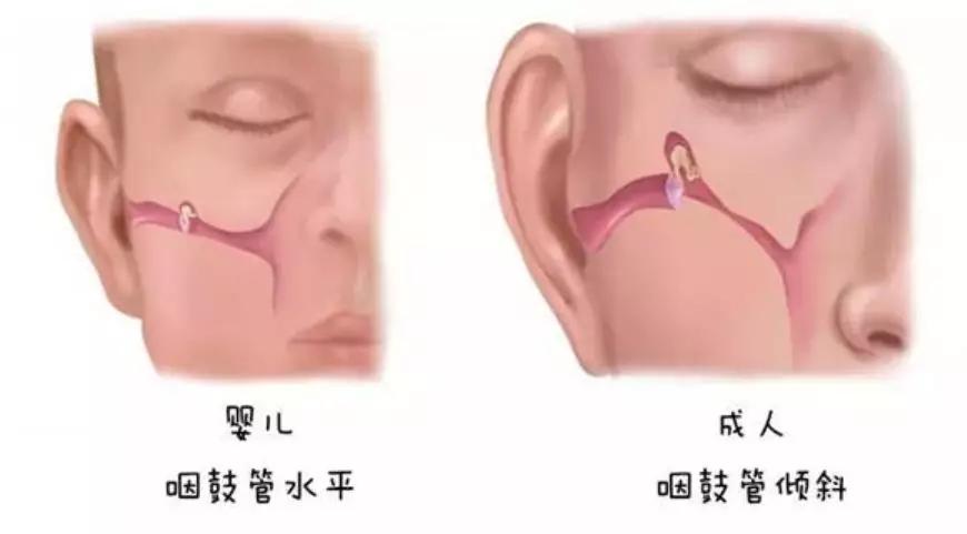 与大点的孩子和成人相比,年龄小的宝宝咽鼓管比较短,比较窄,而且位置
