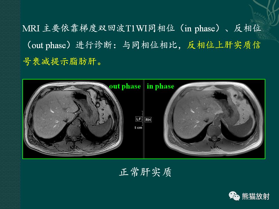 肝臟常見病變丨ct及mri診斷