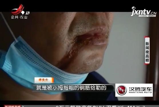 男子和同伴一起骑自行车游玩却被赛道上的钢绳割烂嘴