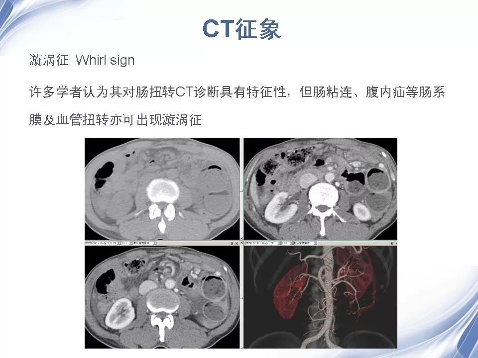 小肠扭转x线图片图片