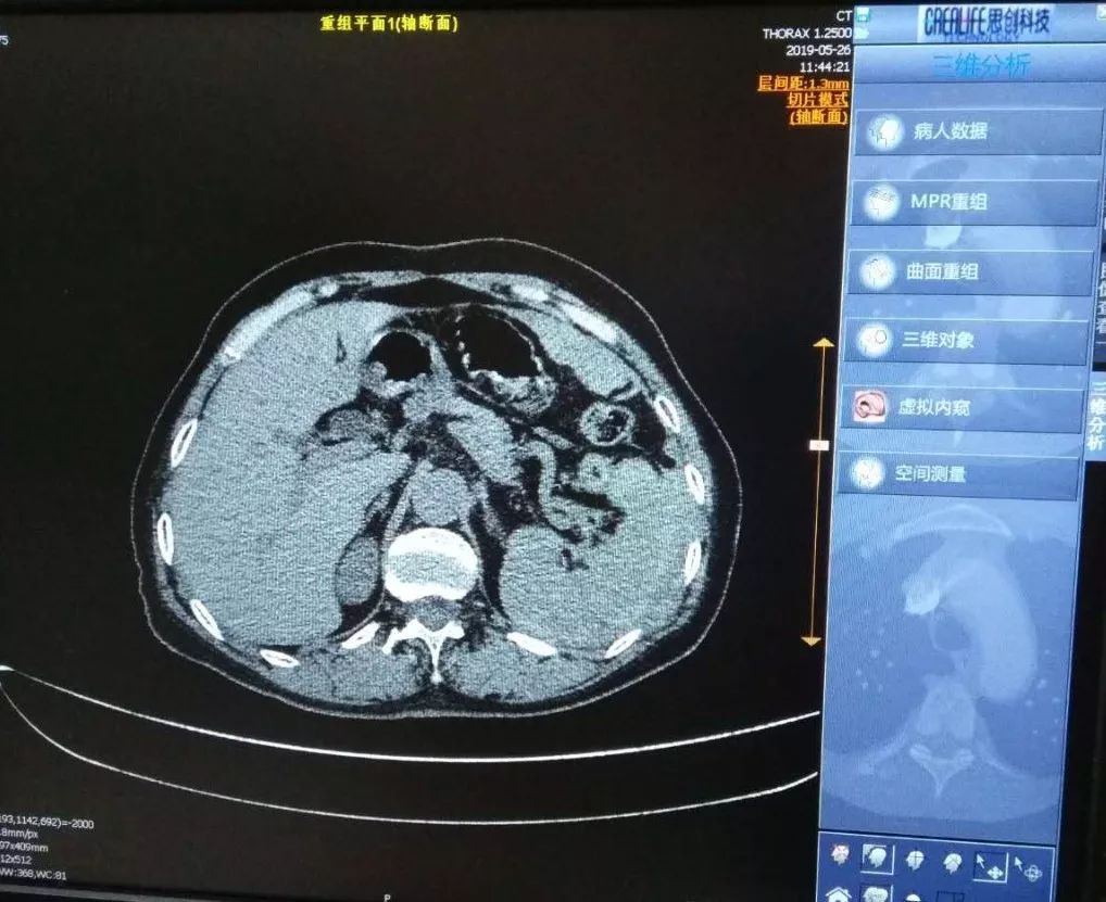 脾破裂ct影像表现图片图片
