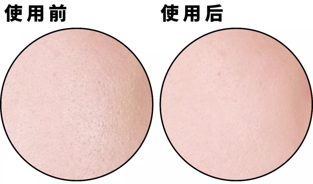 把它们扣掉导致毛孔越变越大虽然巨大毛孔还在但已经比之前好了很多!