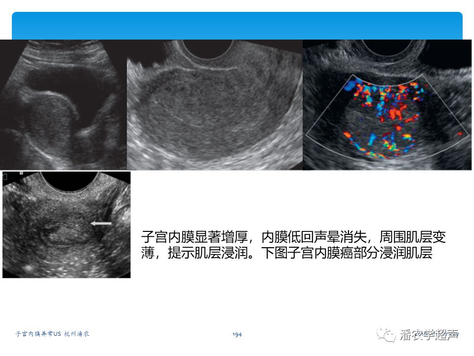 子宮內膜癌的超聲診斷