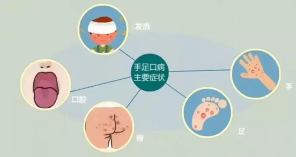 手足口病和皰疹性咽峽炎進入高發期寶寶出現這些症狀千萬要小心