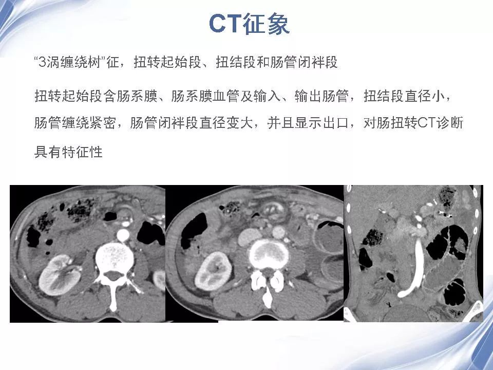 肠扭转 影像图片