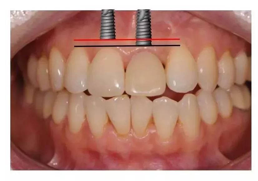 種植體要離鄰近牙槽嵴頂約2-3mm,離未來種植冠唇側遊離齦下3mm左右,薄