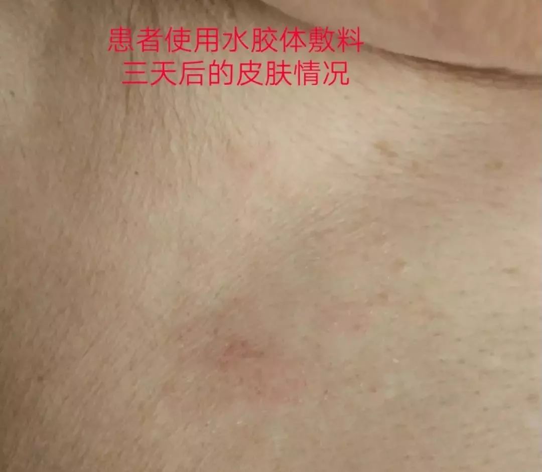 电极片过敏致皮肤破溃,这样改良实特高明,一箭双雕!_患者