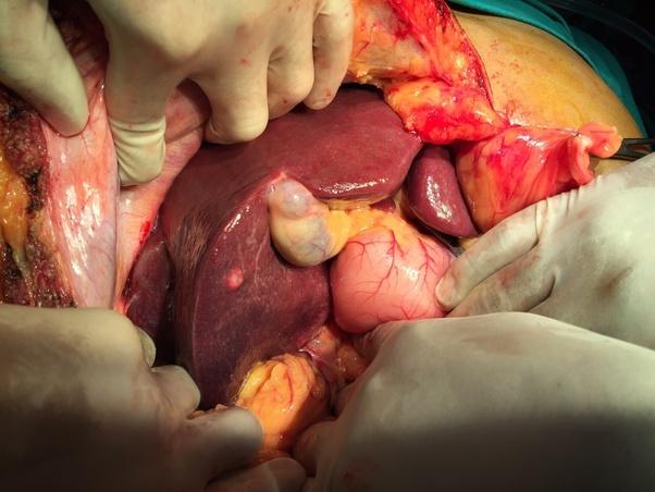 肝脏内部是柔韧的纤维组织,其中左侧最大的部分是朝向腹腔外的,在腹部