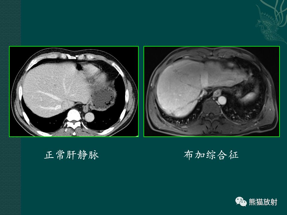 肝臟常見病變丨ct及mri診斷