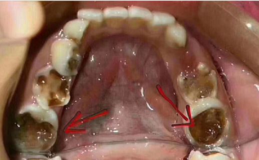 儿童牙齿问题需要引起家长重视——如果人生有"起跑线",那它就在每个