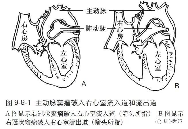 主动脉窦解剖图图片