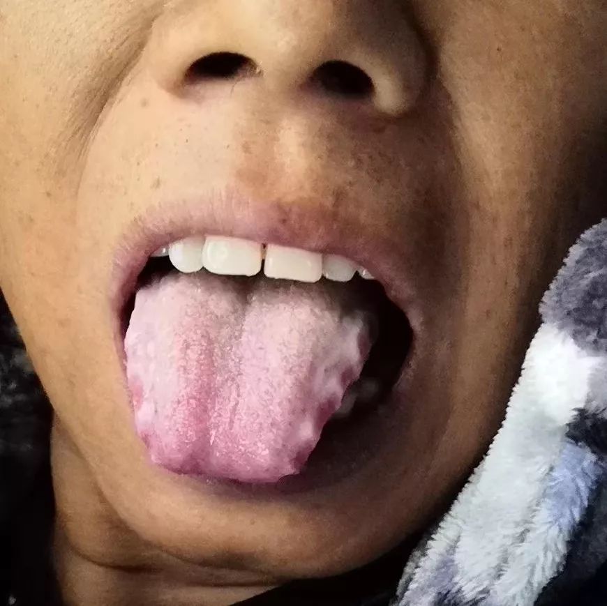 胆结石的舌象图片图片