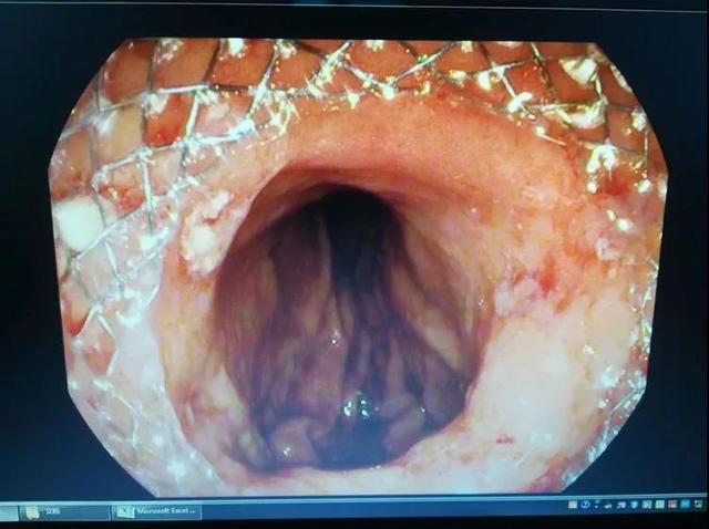 豫东医院成功完成院内首例食管狭窄扩张及支架植入术