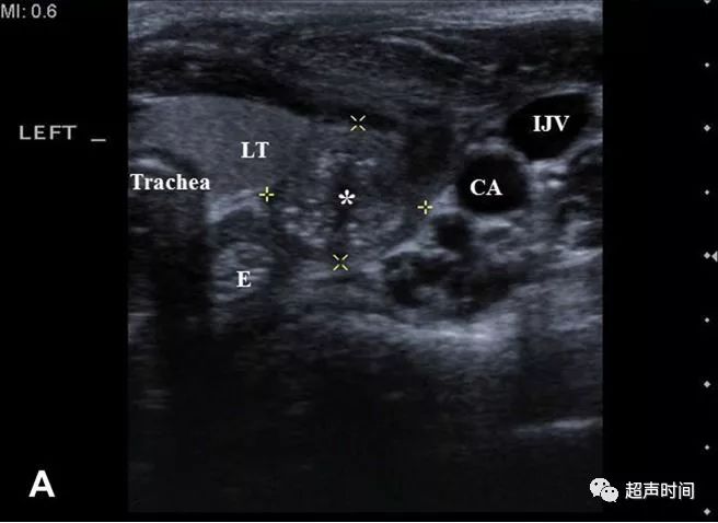 超声高手进阶累及甲状腺的梨状隐窝瘘