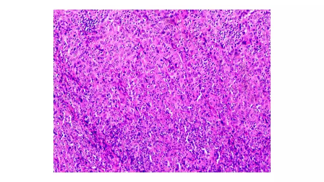 扁桃体肿物病例讨论