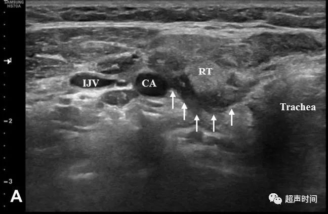 超声高手进阶累及甲状腺的梨状隐窝瘘
