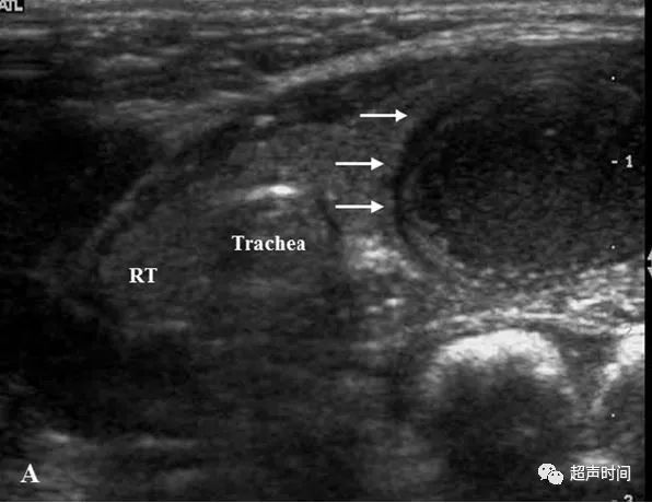 超声高手进阶累及甲状腺的梨状隐窝瘘