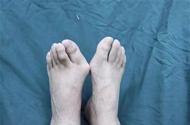 踇外翻是足部常见复杂的解剖畸形,是踇趾在第一跖趾关节处向外侧偏斜