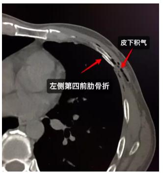 肋骨ct断层图解图片