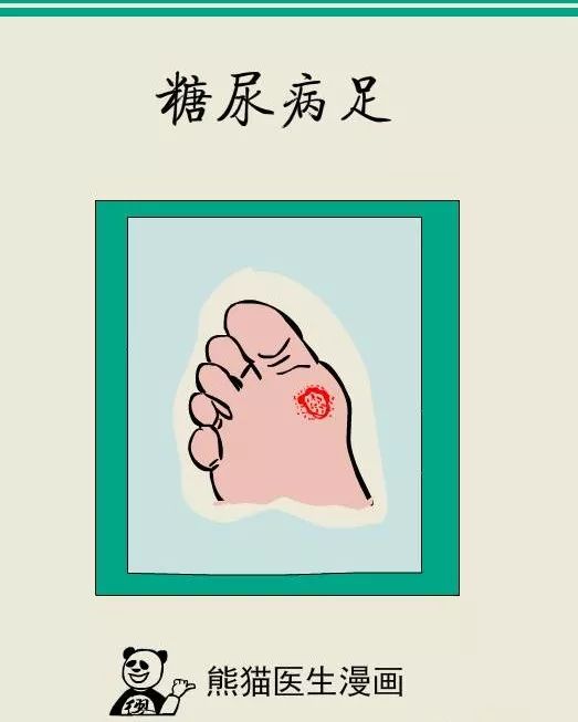 漫画说糖尿病足一定要重视可能会截肢