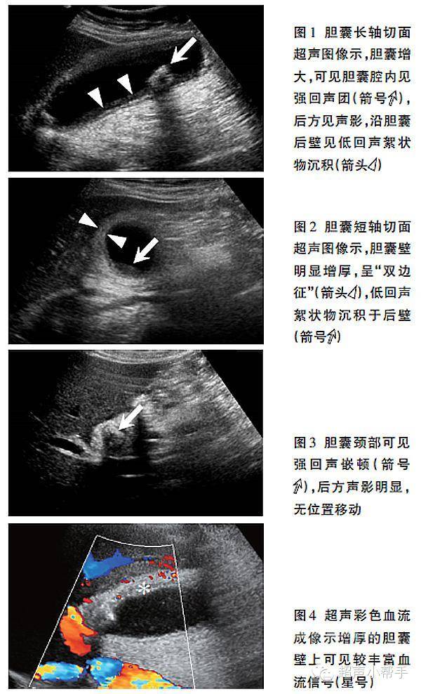 急性胆囊炎的超声表现