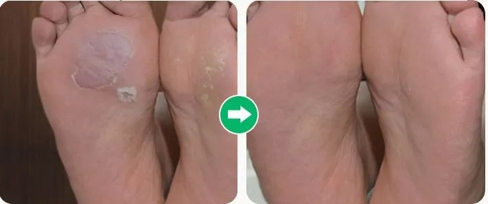 脚气熏天超尴尬这个除菌喷雾7天拯救小臭脚