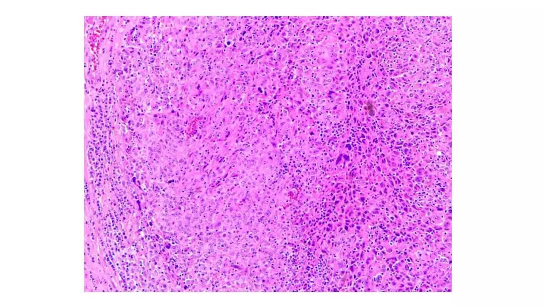 扁桃体肿物病例讨论