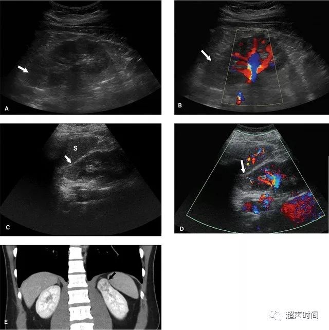 肾肿瘤超声声像图图片