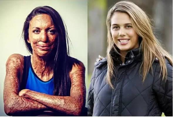 原创16岁女孩因火灾毁容暖心弟弟表示嫁不出去我娶你